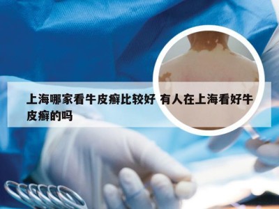 上海哪家看牛皮癣比较好 有人在上海看好牛皮癣的吗