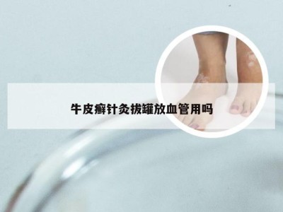 牛皮癣针灸拔罐放血管用吗