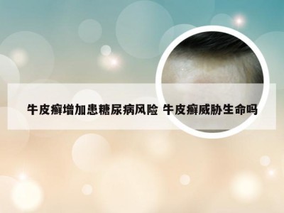 牛皮癣增加患糖尿病风险 牛皮癣威胁生命吗