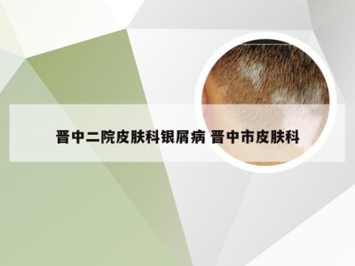 晋中二院皮肤科银屑病 晋中市皮肤科