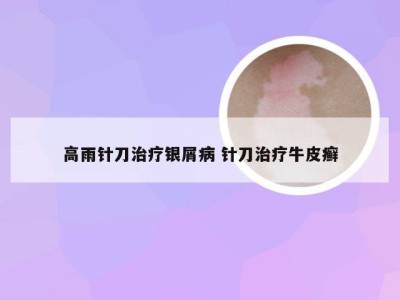 高雨针刀治疗银屑病 针刀治疗牛皮癣
