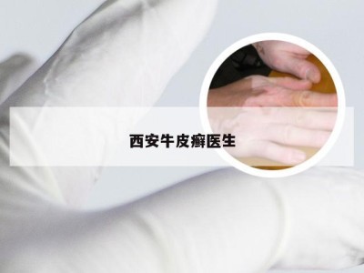 西安牛皮癣医生