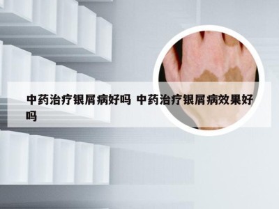 中药治疗银屑病好吗 中药治疗银屑病效果好吗