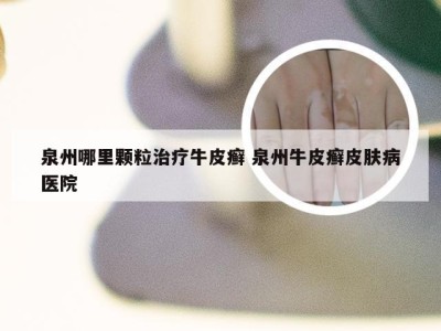 泉州哪里颗粒治疗牛皮癣 泉州牛皮癣皮肤病医院