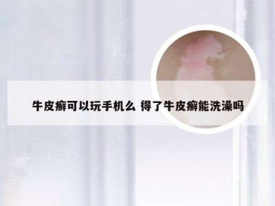 牛皮癣可以玩手机么 得了牛皮癣能洗澡吗