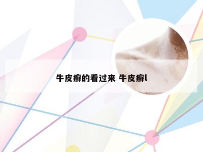 牛皮癣的看过来 牛皮癣l