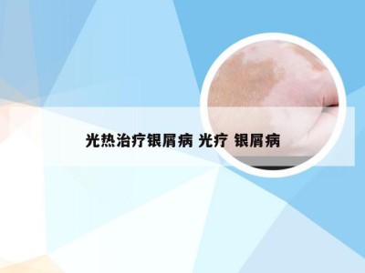 光热治疗银屑病 光疗 银屑病