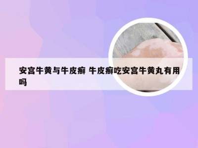 安宫牛黄与牛皮癣 牛皮癣吃安宫牛黄丸有用吗