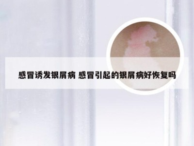 感冒诱发银屑病 感冒引起的银屑病好恢复吗