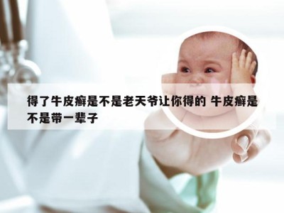 得了牛皮癣是不是老天爷让你得的 牛皮癣是不是带一辈子