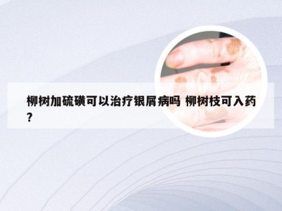 柳树加硫磺可以治疗银屑病吗 柳树枝可入药?