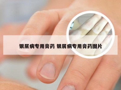 银屑病专用膏药 银屑病专用膏药图片