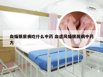 血燥银屑病吃什么中药 血虚风燥银屑病中药方