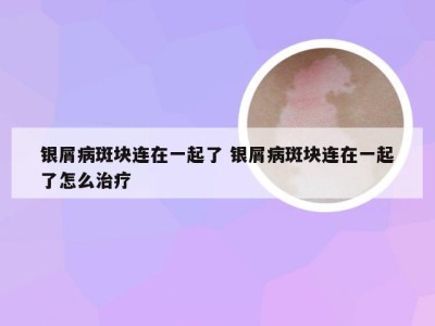 银屑病斑块连在一起了 银屑病斑块连在一起了怎么治疗