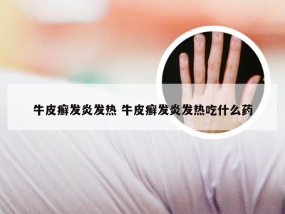 牛皮癣发炎发热 牛皮癣发炎发热吃什么药