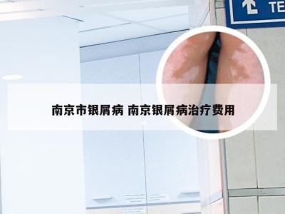 南京市银屑病 南京银屑病治疗费用