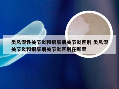 类风湿性关节炎和银屑病关节炎区别 类风湿关节炎和银屑病关节炎区别在哪里