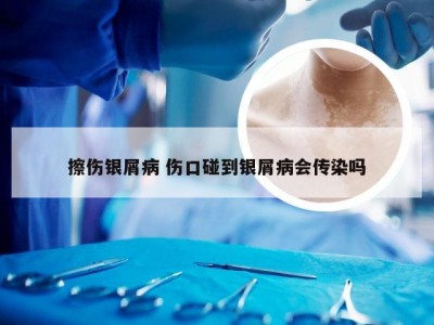 擦伤银屑病 伤口碰到银屑病会传染吗
