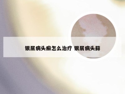 银屑病头癣怎么治疗 银屑病头藓
