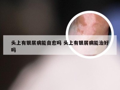 头上有银屑病能自愈吗 头上有银屑病能治好吗