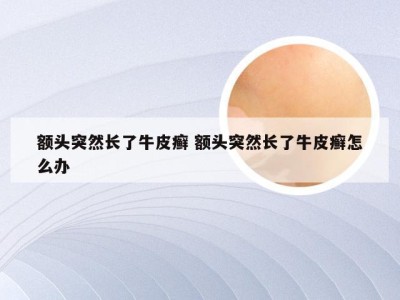 额头突然长了牛皮癣 额头突然长了牛皮癣怎么办