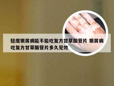 轻度银屑病能不能吃复方甘草酸苷片 银屑病吃复方甘草酸苷片多久见效