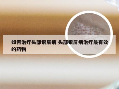 如何治疗头部银屑病 头部银屑病治疗最有效的药物