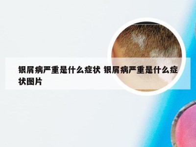 银屑病严重是什么症状 银屑病严重是什么症状图片