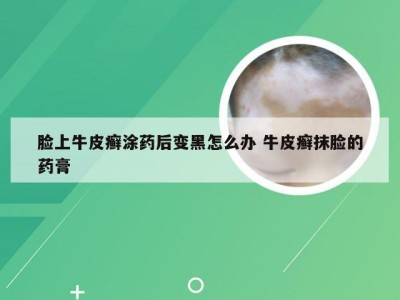 脸上牛皮癣涂药后变黑怎么办 牛皮癣抹脸的药膏