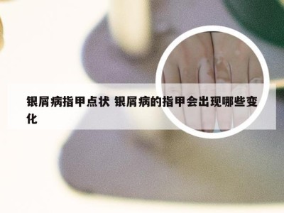 银屑病指甲点状 银屑病的指甲会出现哪些变化