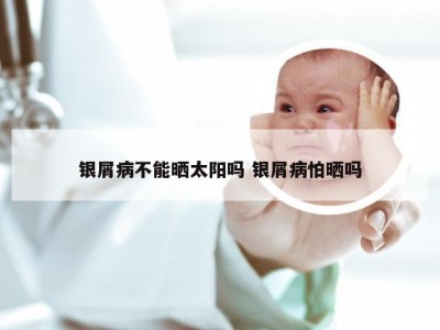 银屑病不能晒太阳吗 银屑病怕晒吗