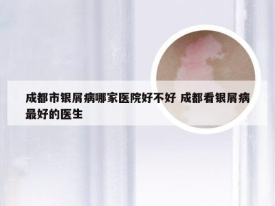 成都市银屑病哪家医院好不好 成都看银屑病最好的医生