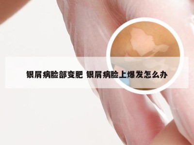银屑病脸部变肥 银屑病脸上爆发怎么办