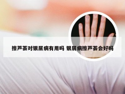 擦芦荟对银屑病有用吗 银屑病擦芦荟会好吗