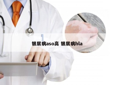 银屑病aso高 银屑病hla