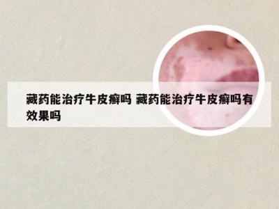藏药能治疗牛皮癣吗 藏药能治疗牛皮癣吗有效果吗