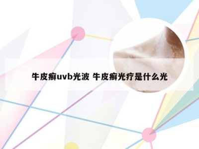 牛皮癣uvb光波 牛皮癣光疗是什么光