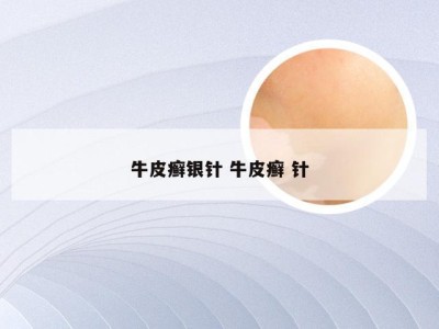 牛皮癣银针 牛皮癣 针