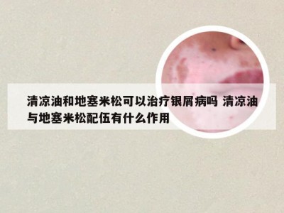 清凉油和地塞米松可以治疗银屑病吗 清凉油与地塞米松配伍有什么作用
