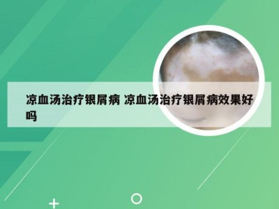 凉血汤治疗银屑病 凉血汤治疗银屑病效果好吗