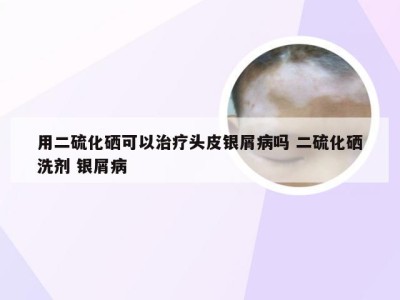 用二硫化硒可以治疗头皮银屑病吗 二硫化硒洗剂 银屑病