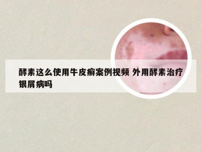 酵素这么使用牛皮癣案例视频 外用酵素治疗银屑病吗