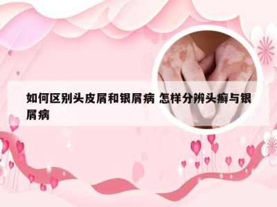 如何区别头皮屑和银屑病 怎样分辨头癣与银屑病