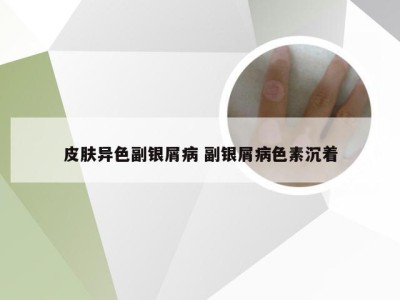 皮肤异色副银屑病 副银屑病色素沉着
