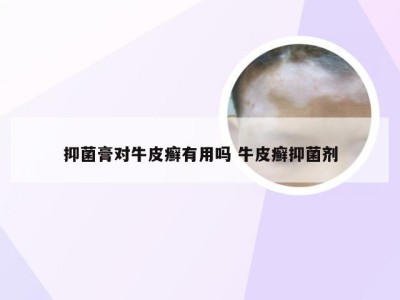 抑菌膏对牛皮癣有用吗 牛皮癣抑菌剂
