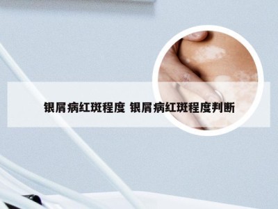 银屑病红斑程度 银屑病红斑程度判断