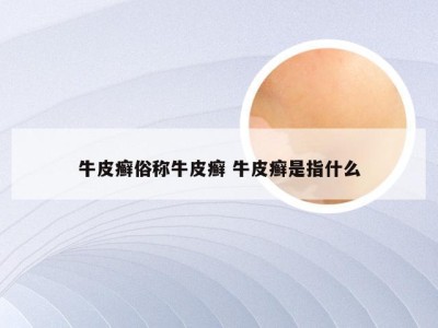 牛皮癣俗称牛皮癣 牛皮癣是指什么