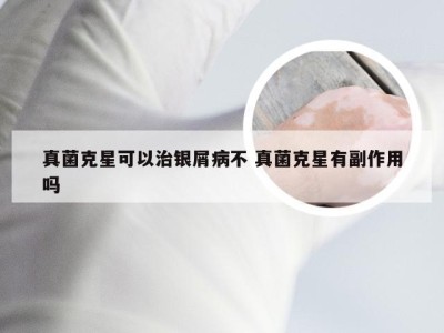 真菌克星可以治银屑病不 真菌克星有副作用吗