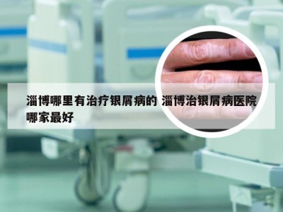 淄博哪里有治疗银屑病的 淄博治银屑病医院哪家最好