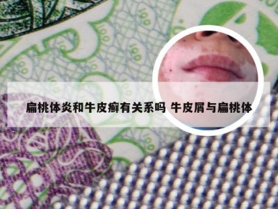 扁桃体炎和牛皮癣有关系吗 牛皮屑与扁桃体